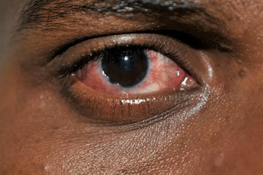 Red Eyes Disease Outbreak In Prisons, Schools Worries Health Ministry